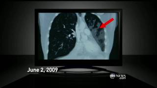 Genetically Screening Cancer Tumors