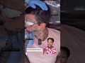 Full face tattoo removal