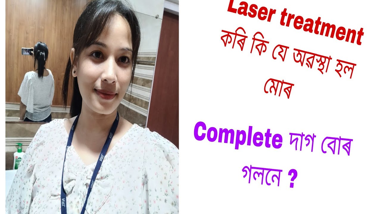Freckles treatment ||Laser treatment in Guwahati || মোৰ মুখৰ দাগ বোৰ একেবাৰে গলনে?