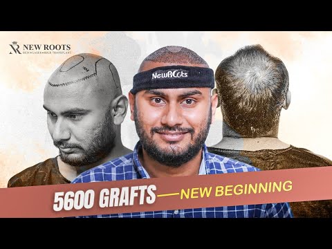 Experienced Doctors + Great Support Staff ❤️ | Hair Transplant in Kolkata | New Roots | Bengali