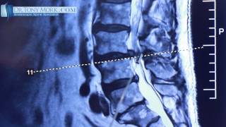 Discectomy vs Laminotomy by Dr. Tony Mork