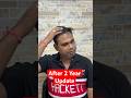 My update after 1 year of hair transplant at Bhopal Hair fall or hair gain #viral  #youtubeshort