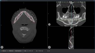 Implant 3D Tutorial - Trace Panoramic