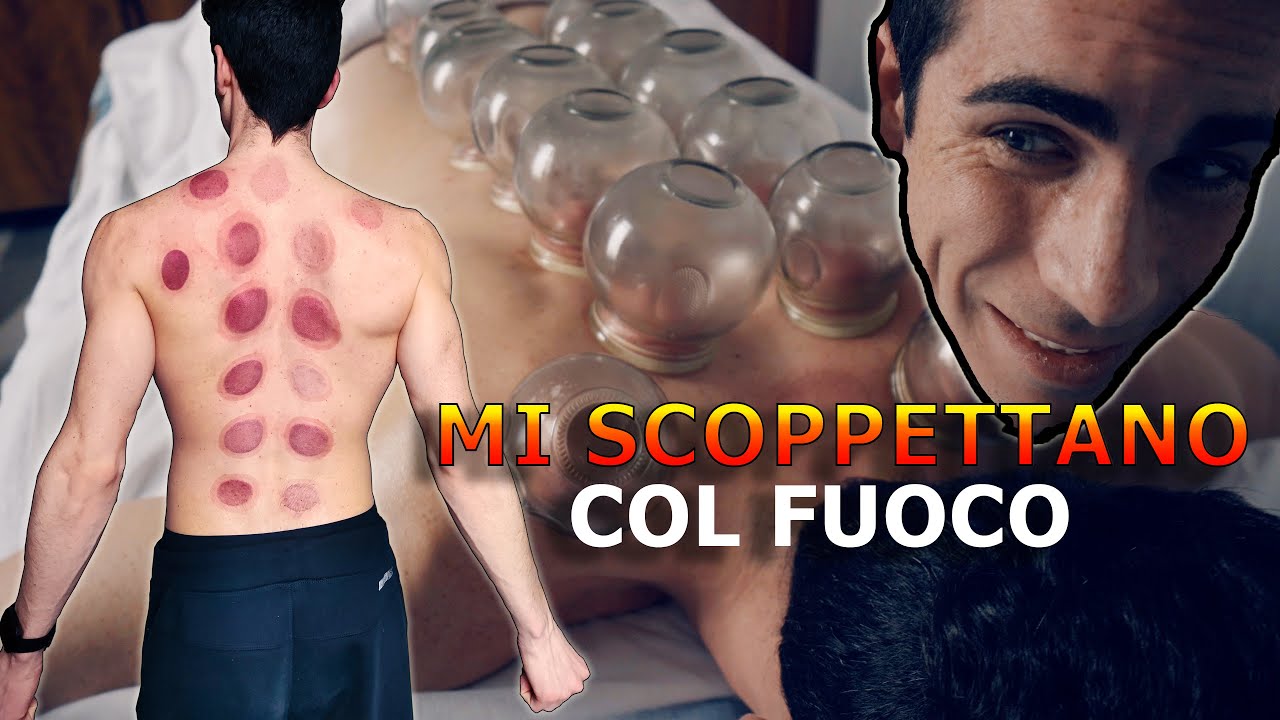 HO PROVATO la TERAPIA di COPPETTAZIONE COL FUOCO in Cina! (Cupping therapy cinese)