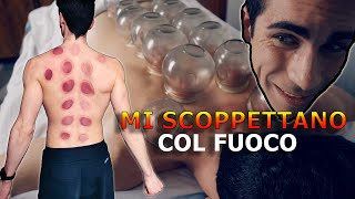 FIRE CUPPING EXPLAINED! Chinese cupping therapy benefits