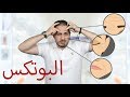 البوتكس | النتائج والمضاعفات