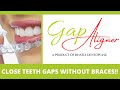 GapAlign: Now Close Teeth Gaps WITHOUT BRACES at Home!! बिना ब्रेसेस - गैप अलाइन !Dr. Srishti Bhatia