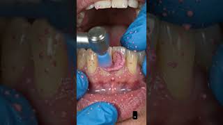Dirtiest Teeth Deep Cleaning Process! 😱 (Satisfying ASMR) #SatisfyingVideo #ASMR #Transformation