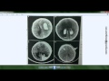 شرح الأشعة المقطعية على الرأس CT scan, Head د. محمود سويلم