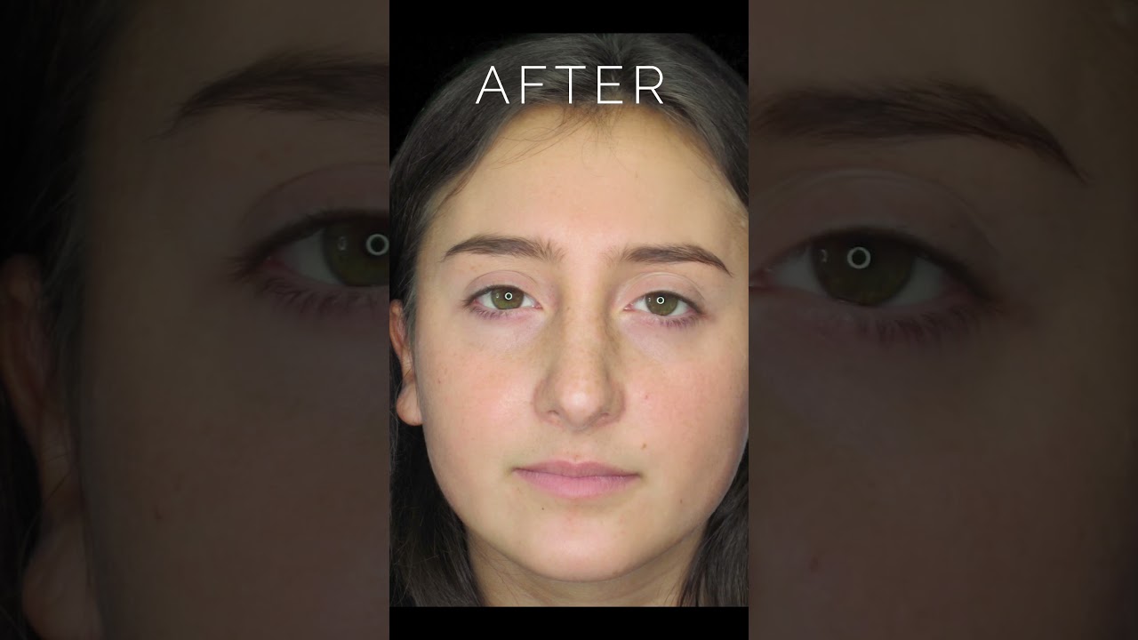 Before & After Nose Job Surgery: Dorsal Hump & Ptotic Tip 