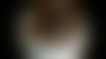 PMMA IOL in Fluid-filled Vitrectomized eye. Ahmed Assaf