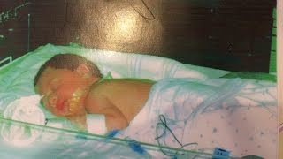 Duodenal Atresia - My Pregnancy and Baby's NICU stay