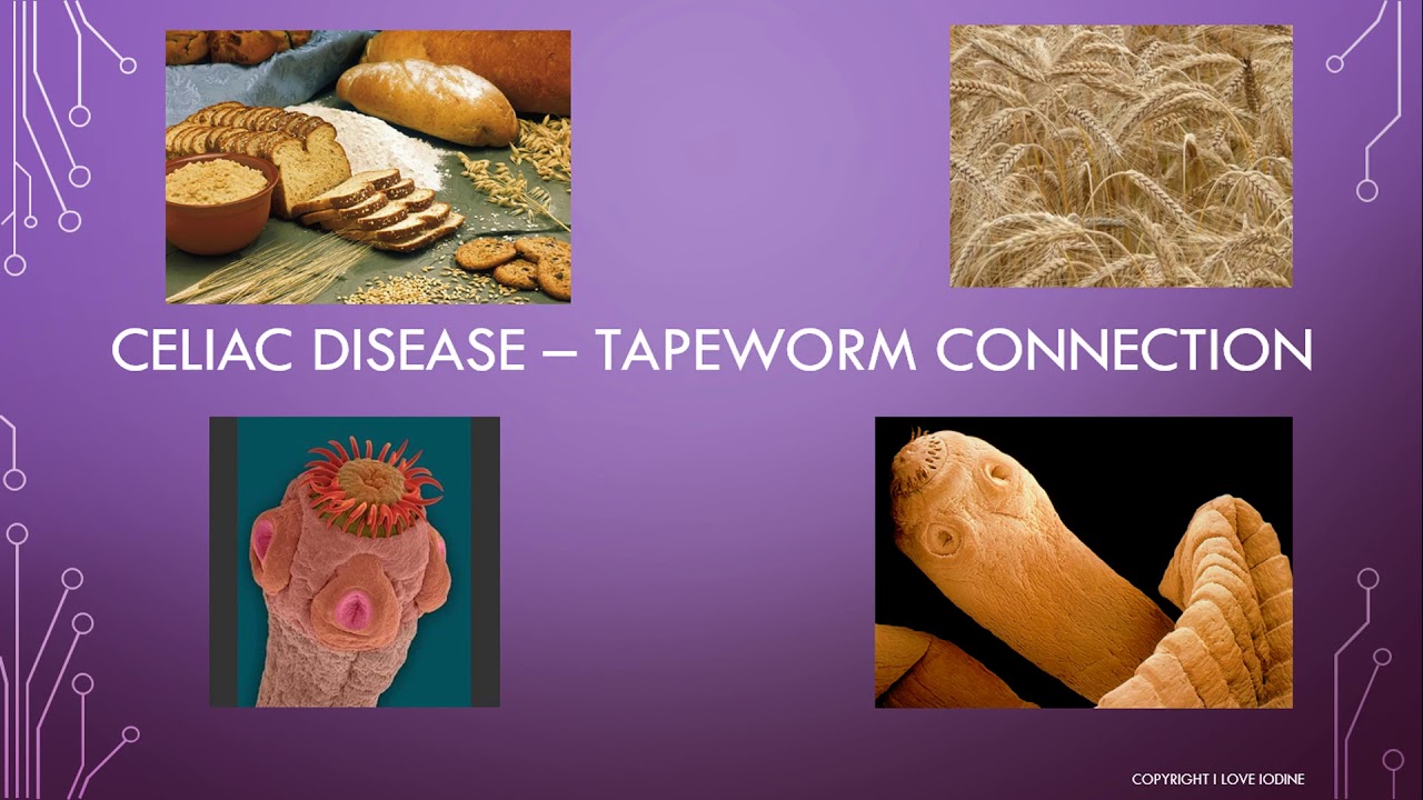 Celiac, Gluten Intolerance, & Tapeworms - Connecting the Dots - YouTube