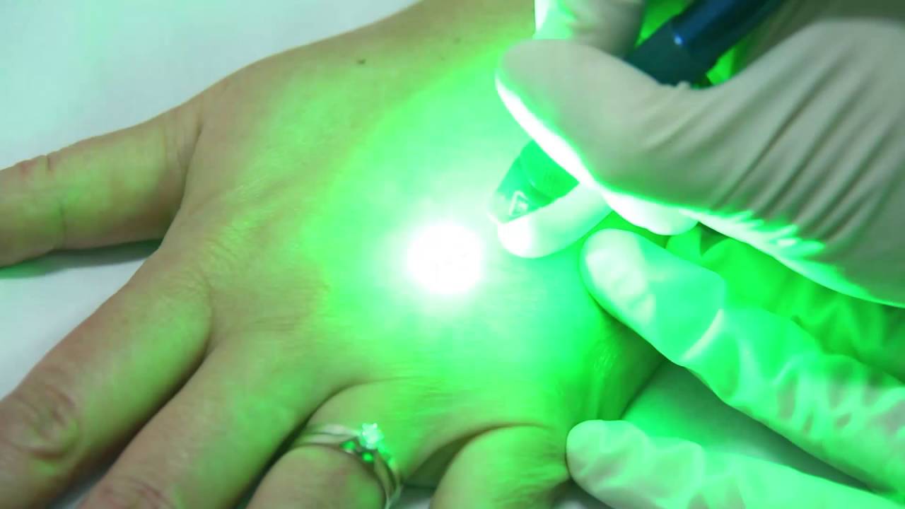 Pigmentation Treatment of the Hand & Arms Cosmetic Laser & Medical
