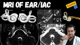 MRI of Ear/IAC Technique | MRI Technique Course-Tutorial-42 |