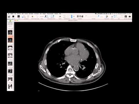 Impella RP (Right-Sided Percutaneous Support Device)