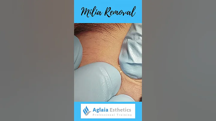MILIA REMOVAL DEMOSTRATION #SHORTS