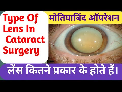Type of IOL Lenses।Cataract Eye Surgery।आंखो में पड़ने वाले लेंस कितने प्रकार के होते हैं।मोतियाबिंद