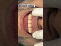 Diseño de sonrisa #dentista #dentist #diseñodesonrisa #smiledesign #veneers #veneer #carillas
