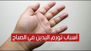 9 أسباب وراء تورم اليدين في الصباح