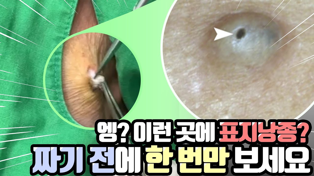 표피낭 피지낭 시술장면공개  ( 피지가짜도짜도 계속 나온다구요? 냄새도 지독하셨나요? )