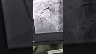 Stenting of Heart vessels, Angioplasty of Right coronary artery health healthy