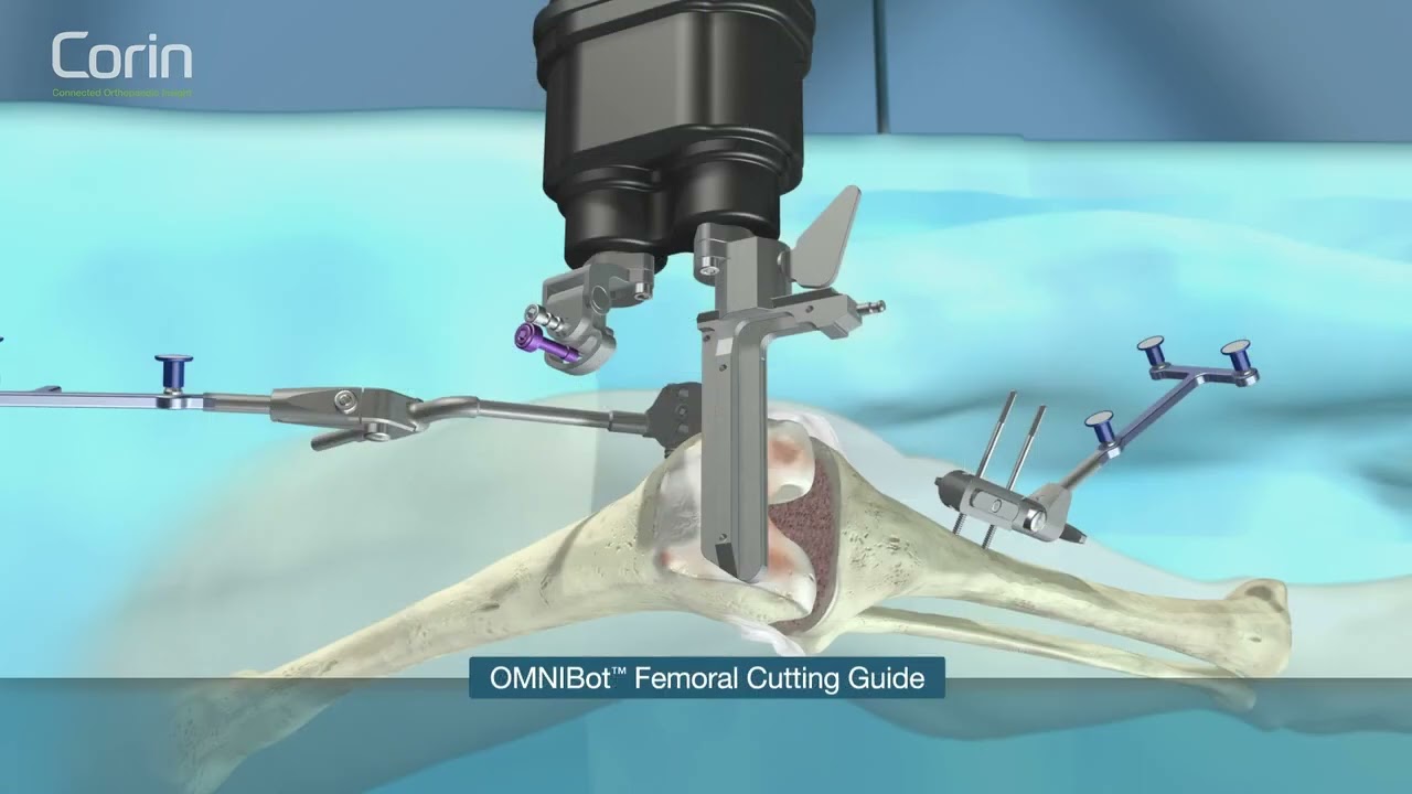 החלפת ברך באמצעות רובוט (אילוסטרציה)