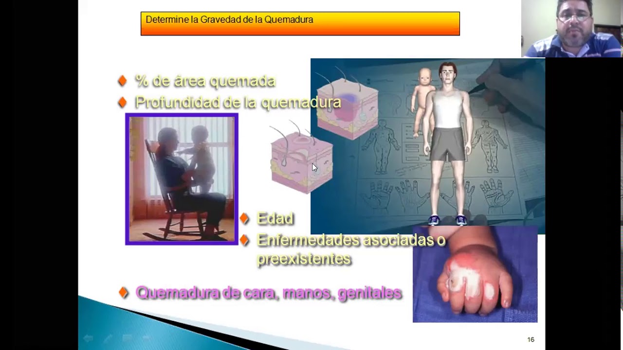 Manejo Fisioterapéutico en pacientes Quemados YouTube