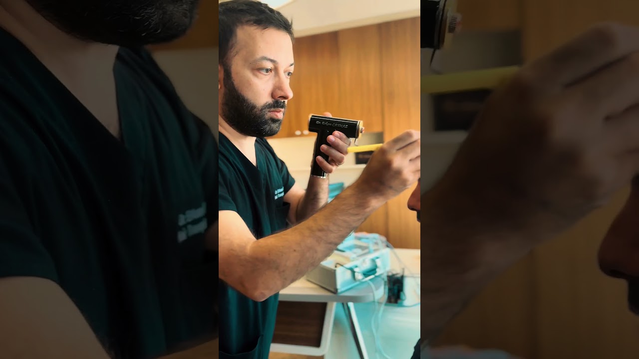 Hairline Design by Dr Caymaz #afrohairtransplant