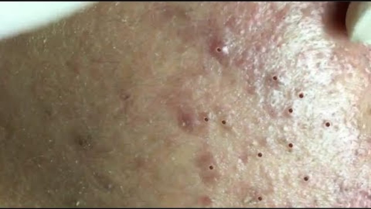 Blackheads removal Rid of Acne YouTube