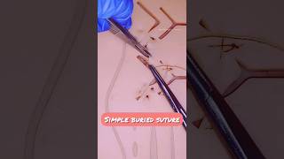 Simple Buried Suture | Suturing techniques