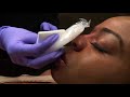 Non Surgical Nose Job by Dr. Naderi