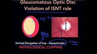 High Yield Topic : Optic Disc Changes in Glaucoma  The Complete Course