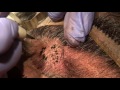 Scalp Micropigmentation (SMP) for Donor Scar Following Hair Transplant
