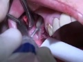 Part1 bilateral sinus lift using with a simultaneous implant place of mis seven implants.