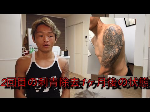 刺青除去1ヶ月後の状態 2回目 Youtube