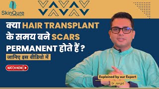 Are Scars Formed During Hair Transplant Permanent? | Hair Transplant by Experts in Delhi