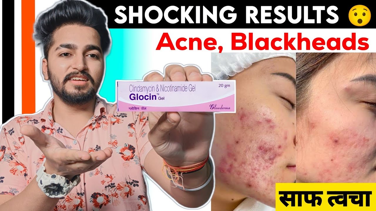 Glocin Gel Review Best Cream For Acne, Pimples, Blackheads YouTube