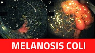 What is Melanosis Coli? : Melanosis Coli Causes-Treatment- Laxatives-Biopsy-Diagnosis
