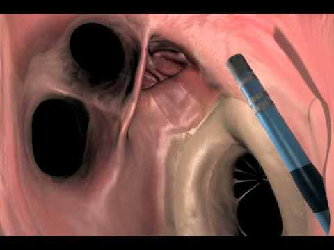 Robotic Navigation with Stereotaxis electrophysiology lab