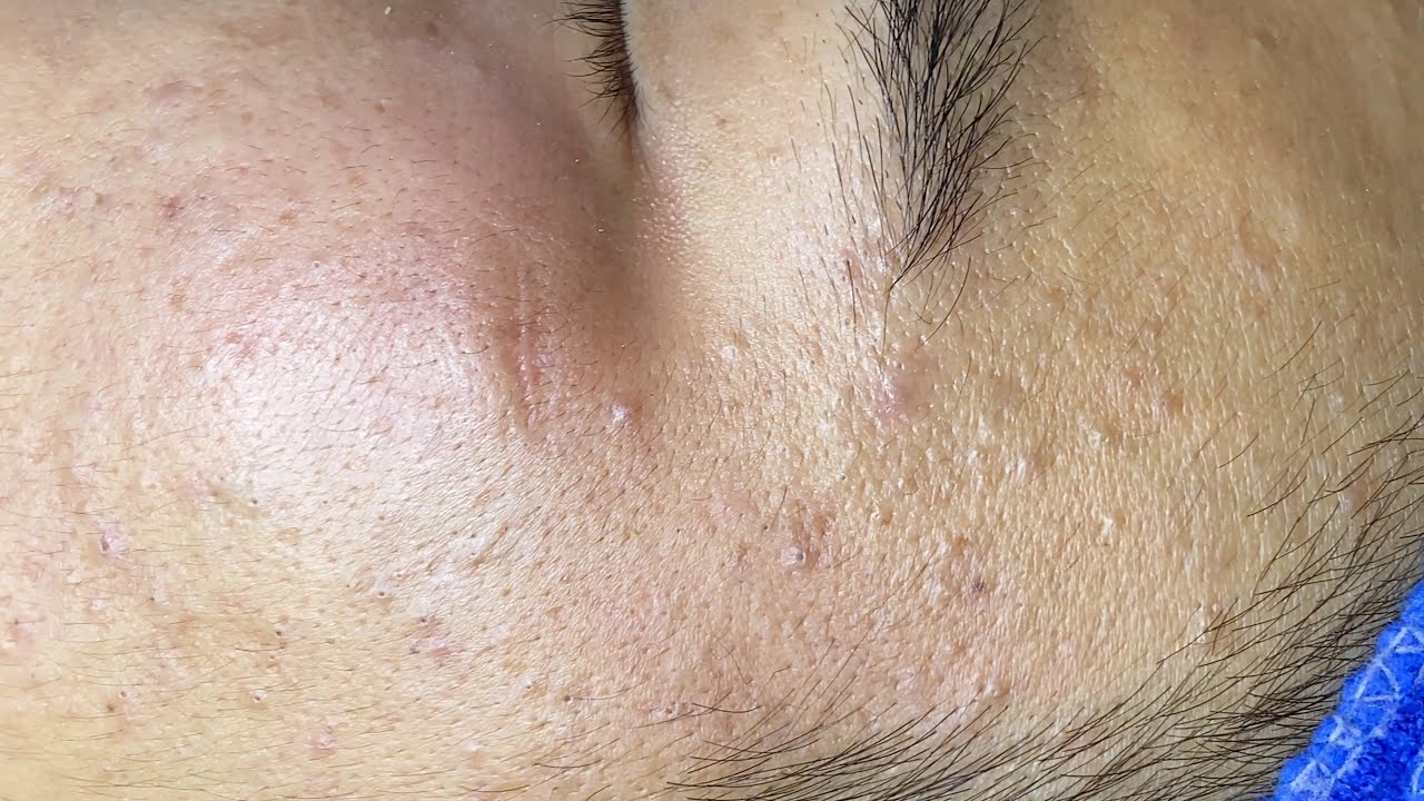Blackheads, Acne Hidden Under The Skin | Mụn Đầu Đen, Mụn Ẩn Dưới Da  - SacDepSpa#264