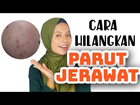 Cara Pudarkan & Hilangkan PARUT Jerawat