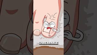 How Doctors Treat a Severe Ingrown Toenail? ⚠️🦶..!!#e2dhealth #animation #2dshow #health #fypシ