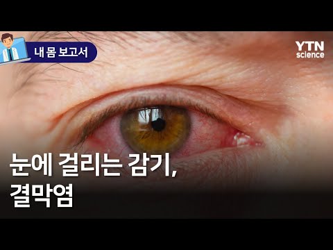 [내 몸 보고서] 눈에 걸리는 감기, 결막염 / YTN 사이언스