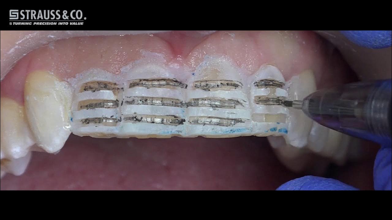 Porcelain Laminate Veneer Preparation Kit by Strauss & Co. YouTube