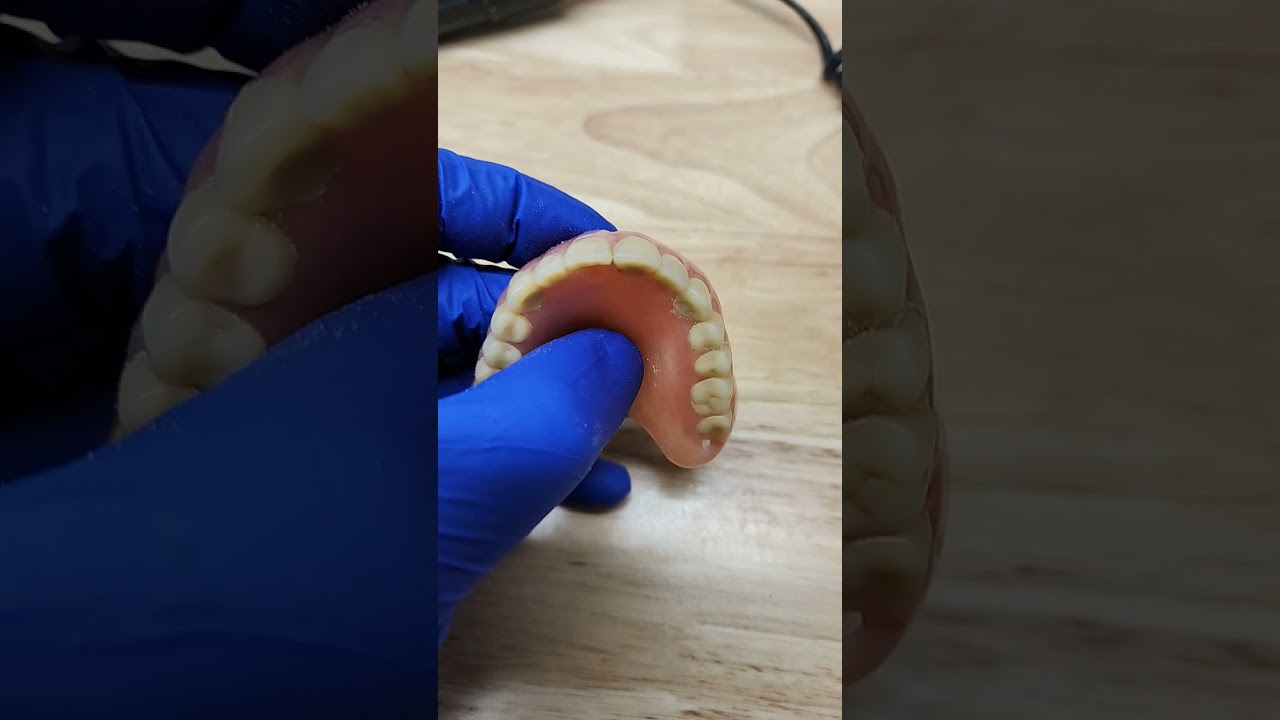lost a tooth 🤯🤯🤯🤯denture repair 