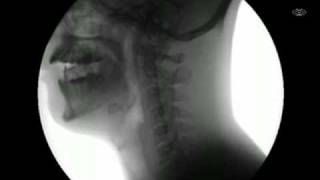 My X Ray swallows(My innards as I eat stuff. Unfortunately, the X-Rays did not give me any sort of super-powers., 2009-09-11T23:55:30.000Z)