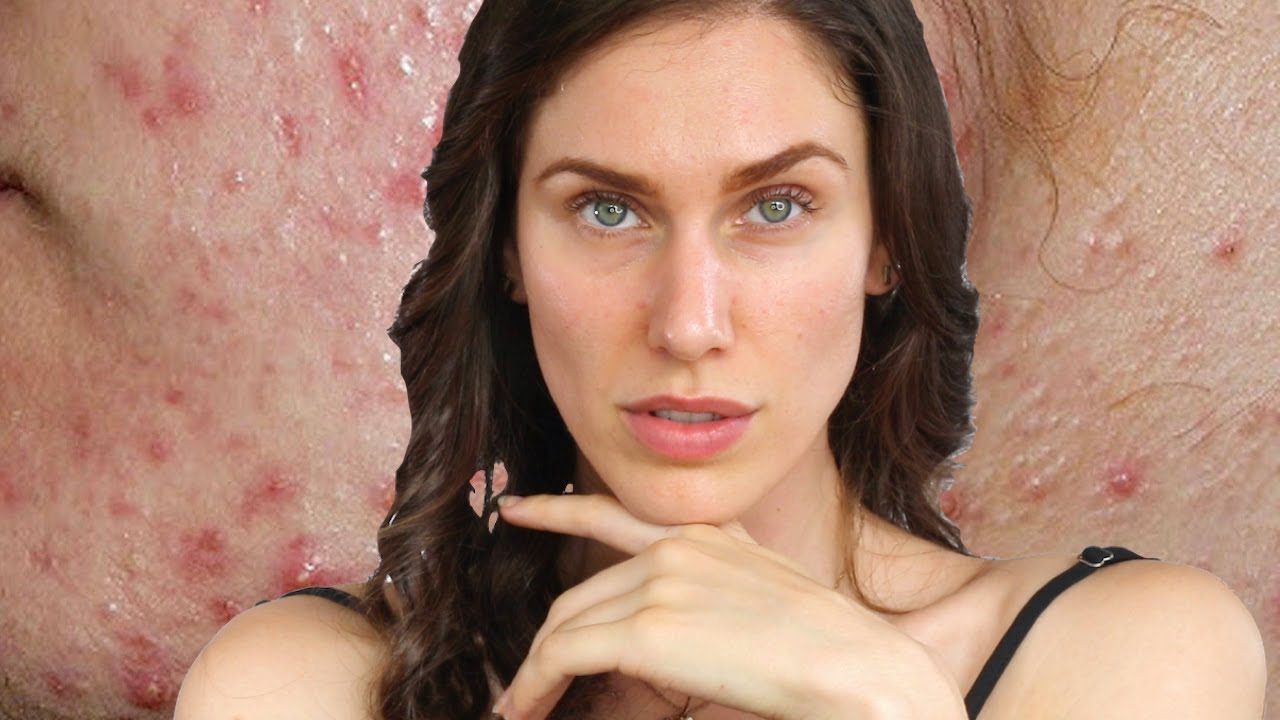 Treating Teenage Acne - How To & What To Look For In Skincare Products For  Teens - YouTube