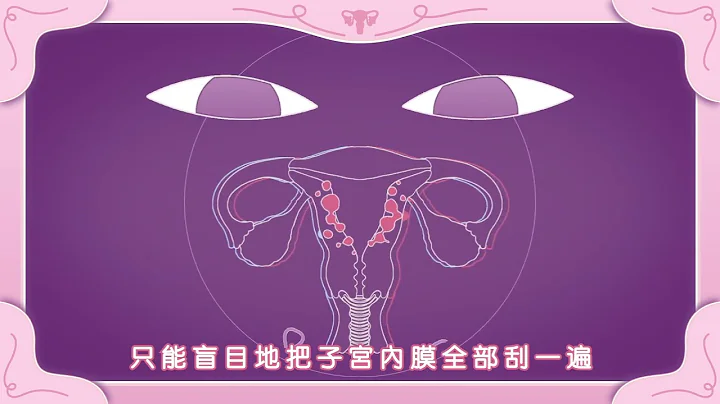 【問8小劇場】子宮息肉如何切除？善用子宮鏡手術無傷口、免住院 - 天天要聞