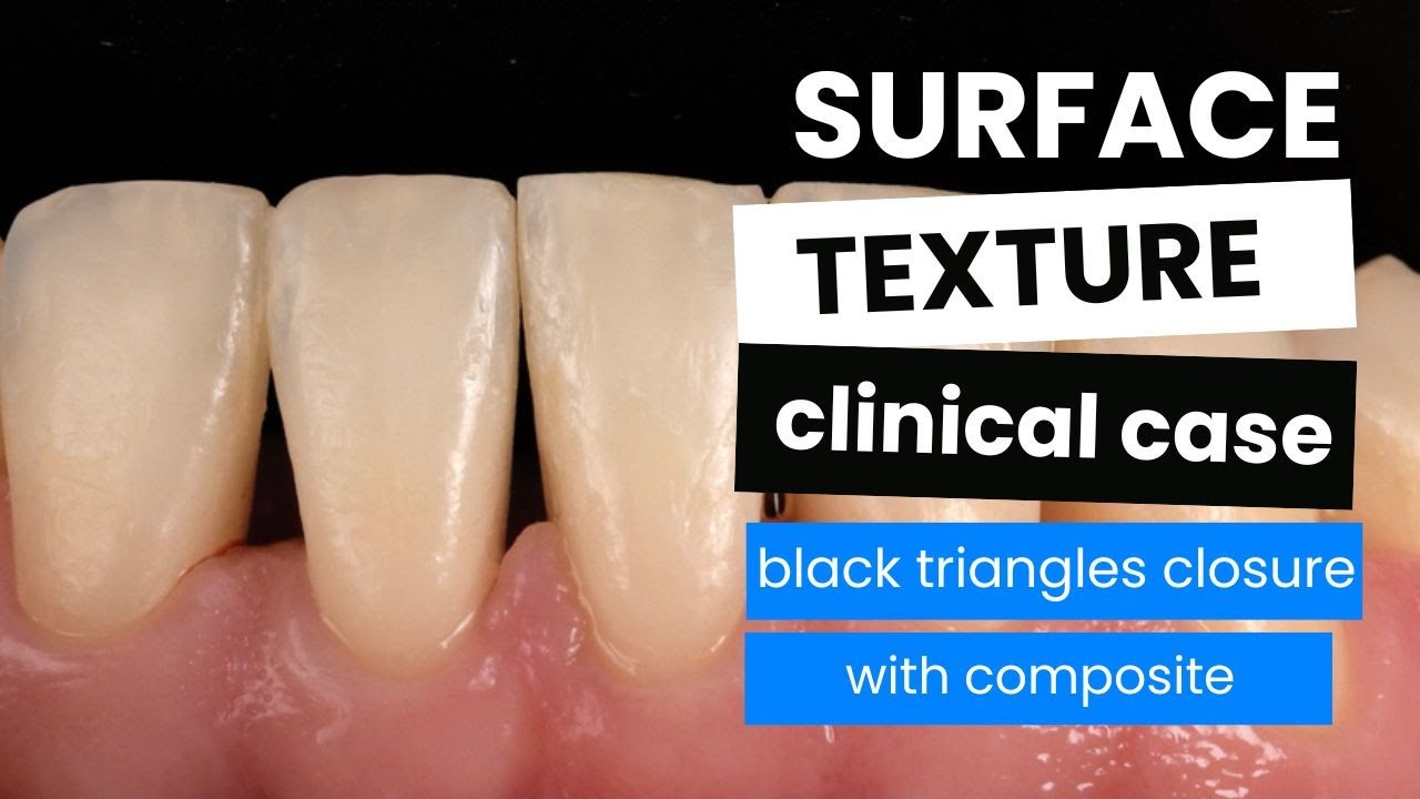 Clinical Case: Black Triangle Closure with Composite